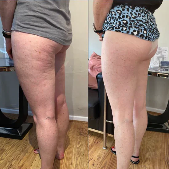 Cellusmooth – Minska Celluliter!