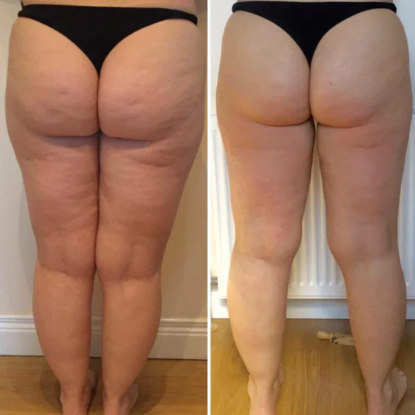 Cellusmooth – Minska Celluliter!